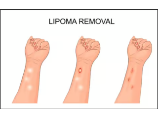 Lipoma treatment in Dubai - Dr Daniel Serralta