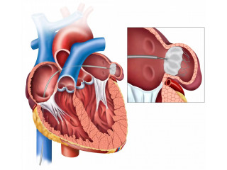 Reduce Stroke Risk with Left Atrial Appendage Closure: A Heart-Saving Procedure