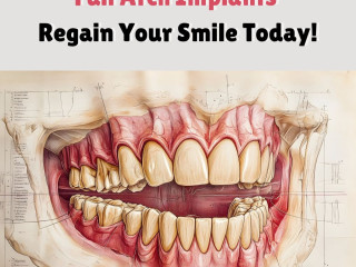 Full Arch Implants - Regain Your Smile Today!