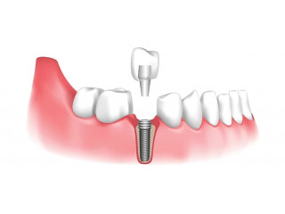 Your Trusted Dental Implants Dentist in Barrie, ON