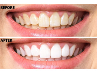 Teeth Whitening in Barrie, ON