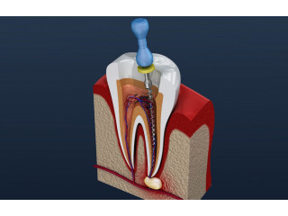 Root Canals in Barrie, ON | Yonge Forest Dental