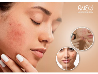 Best Acne Laser Treatment in Bangalore - Anew Cosmetic Clinic