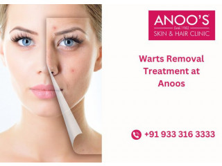 Advanced Warts Removal Treatment at ANOOS