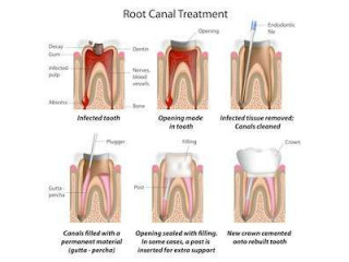 Root Canal Rescue: Unveiling the Treatment that Saves Smiles