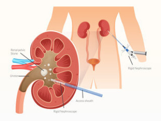 Percutaneous Nephrolithotomy Hospitals in Saltlake