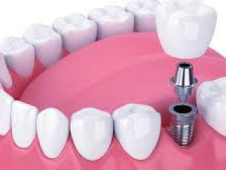 Dental Implants Cost in Coimbatore | Affordable Implants at Shaad Aesthetics