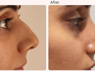 Nose surgery cost in delhi