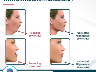 Corrective Jaw (Orthognathic) Surgery in India By Best Oral and Maxillofacial Surgeon