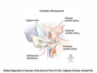 Carotid Doppler Ultrasound: Advanced Radiology for Vascular Health