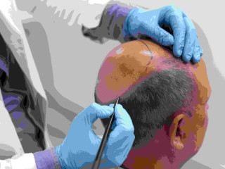 Best Hair Transplant Clinic in Kompally Hyderabad