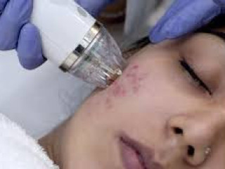 Acne Scar Treatment In Vaishali - Dr. Monica Bambroo