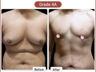 Gynecomastia Treatment in India