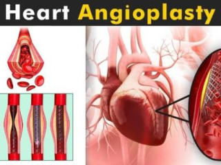 Best Angioplasty Doctor and Surgery in Jaipur – Dr. Ravinder Singh Rao