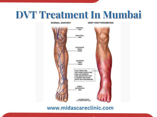 Effective DVT Treatment in Mumbai: Expert Care for Faster Recovery