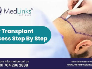 Hair Transplant in Hyderabad