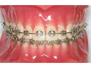 Affordable Dental Braces in Singapore