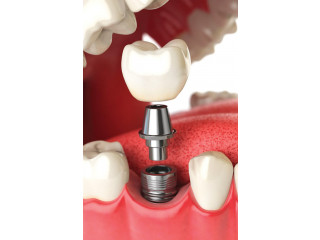 Best dental Implants clinic in Perris | Dentist in Perris | Nuevo