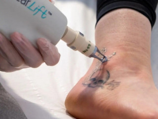 Efficient Tattoo Removal in Arlington - Lumina Laser Beauty
