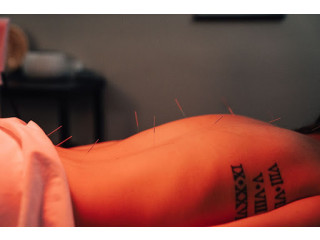 Experience Holistic Healing with Acupuncture in Gahanna, Ohio