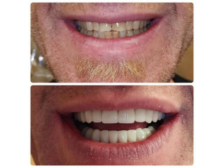 Experience the Difference with Teeth Whitening Services from Dr. Monica Crooks, DDS