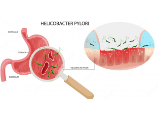 Helicobacter Pylori Treatment by Vitaleenanomed