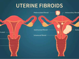 UFE fibroids: The Key to Tackling Large Fibroids