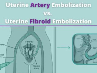 Is Uterine Artery Embolization the Solution for You?