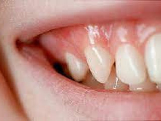 Tooth Decay Treatment in Houston, TX