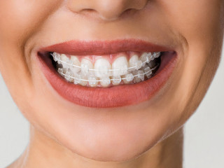 Top Ceramic Braces in Chelsea | Expert Orthodontic Treatment