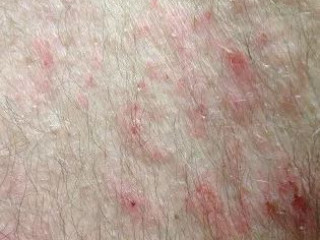 Atopic dermatitis Houston