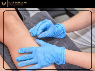 Sclerotherapy for Vein Removal: What You Need to Know Before You Begin