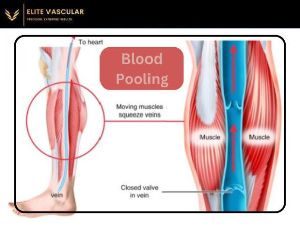 blood-pooling-and-swollen-legs-effective-home-remedies-big-0