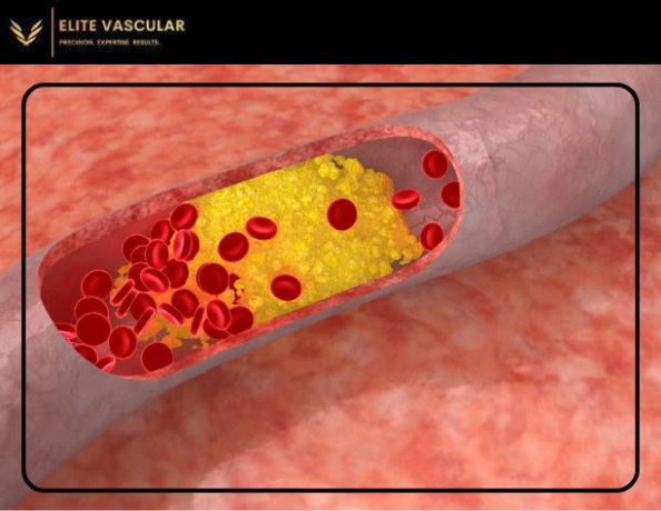 what-is-peripheral-artery-disease-pad-and-how-can-it-be-treated-big-0